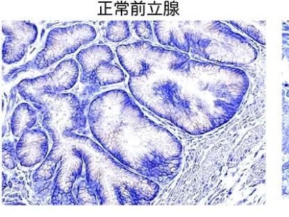范加尔身患前列腺癌，可以通过以下几种方式来缓解