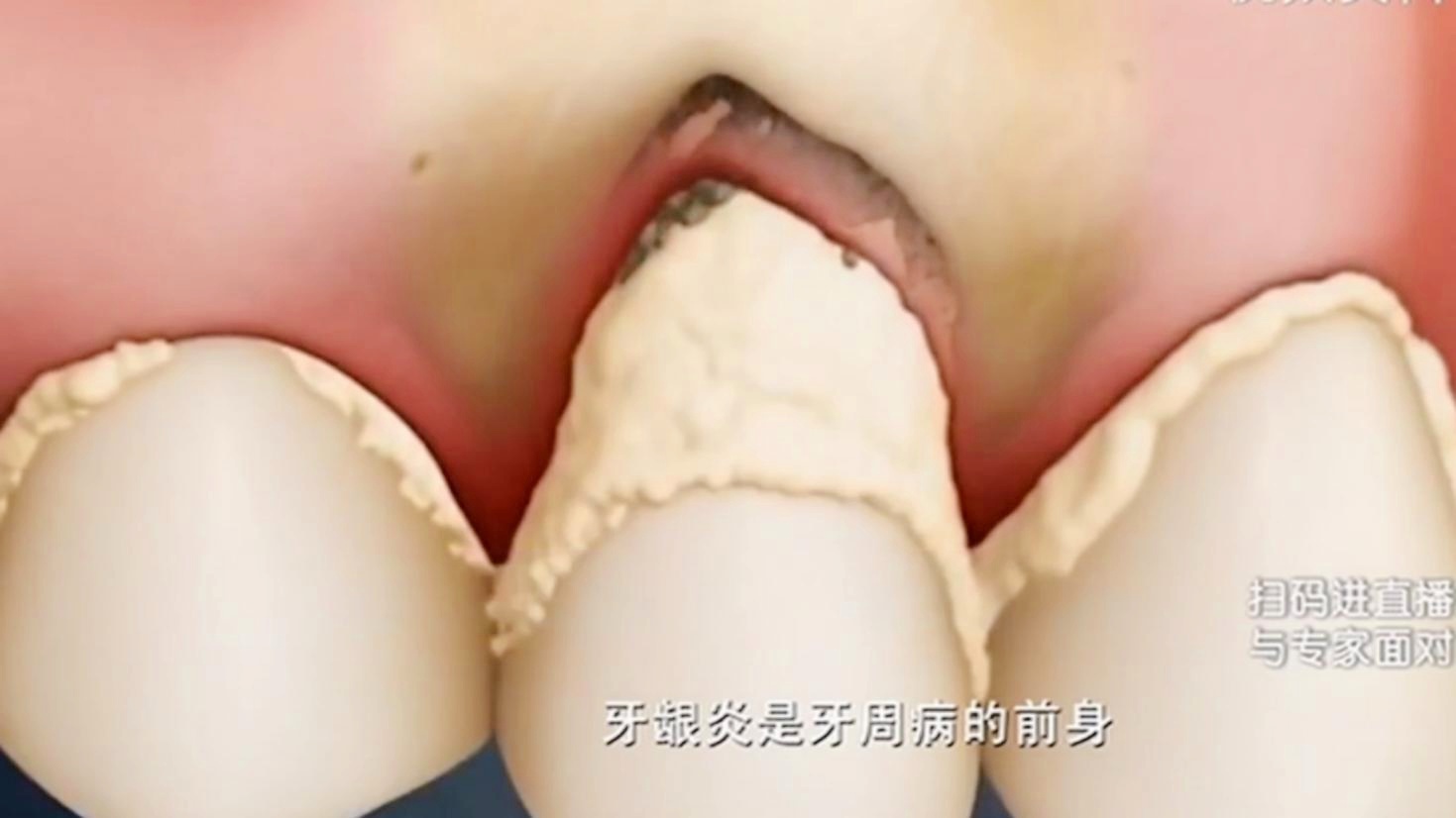 之前_咨询牙周病和牙周炎的相关问题，3小时内吃掉就会导致牙龈发炎
