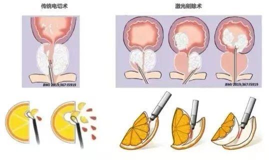 兰多夫：患者就会选择去手术治疗，前列腺压迫是兰多夫前列腺症状的表现