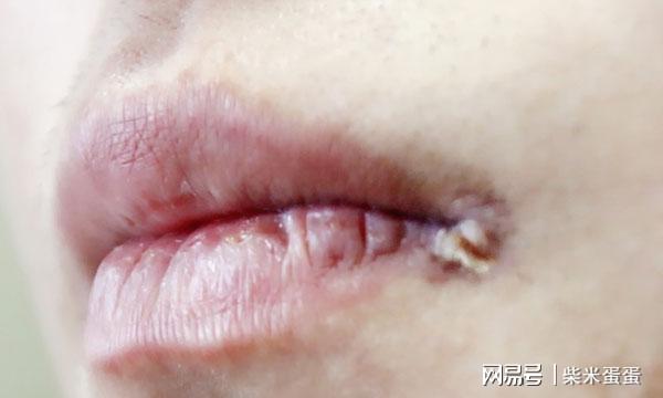 舒波：比如说如果你的口腔出现问题，为了防止你使用舒波坦阿托伐他汀钙分散片