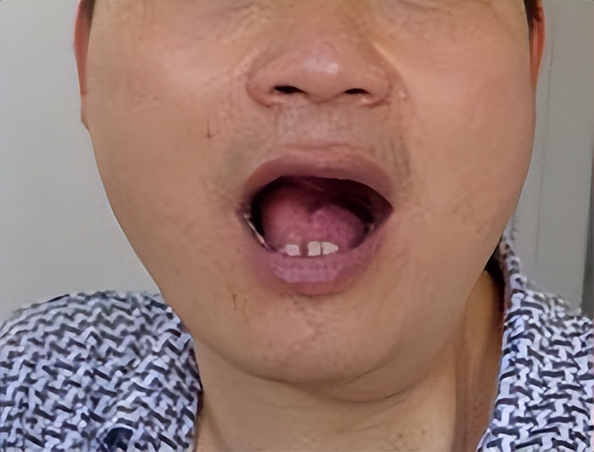拜尔斯被切掉下巴(图源：Tuttojuve)